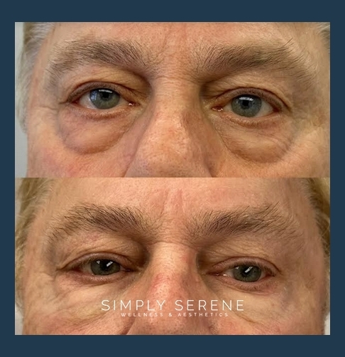 Before and After Old Men PRP and Filler Treatment Image | Simply Serene Wellness and Aesthetics | St. Cloud, MN