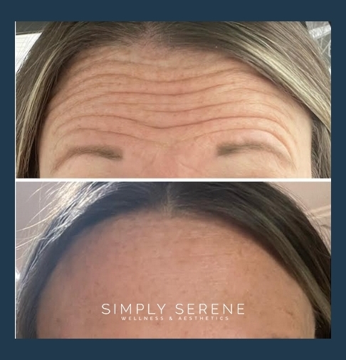 Before and After Botox/Dysport/Xeomin treatment results | Simply Serene Wellness and Aesthetics in St. Cloud, MN