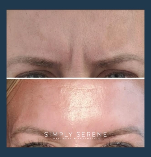 Before and After Botox/Dysport/Xeomin treatment results | Simply Serene Wellness and Aesthetics in St. Cloud, MN