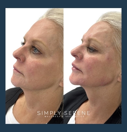 Before and After Jawline treatment results | Simply Serene Wellness and Aesthetics in St. Cloud, MN