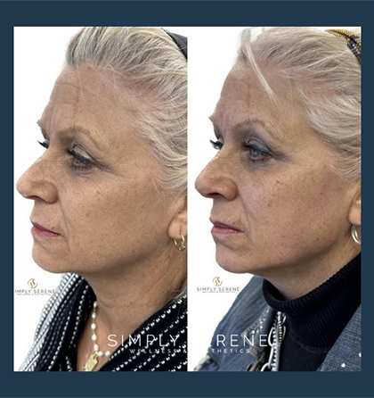 Before and After Jowls/Jawline treatment results | Simply Serene Wellness and Aesthetics in St. Cloud, MN