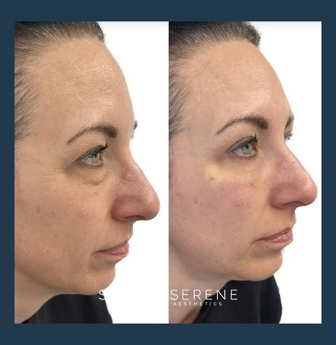 Before and After Women PRP Treatment Image | Simply Serene Wellness and Aesthetics | St. Cloud, MN
