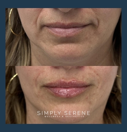Before and After Lips + Smile lines treatment results | Simply Serene Wellness and Aesthetics in St. Cloud, MN