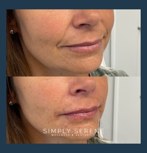 Before and After Nasolabial Fold Smile Lines treatment results | Simply Serene Wellness and Aesthetics in St. Cloud, MN