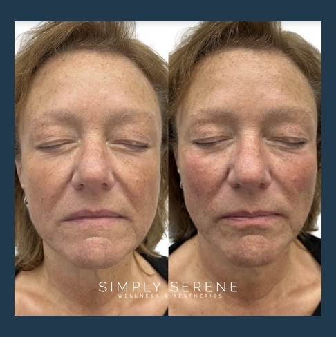 Before and After Old Women Cheek Filler Treatment Image | Simply Serene Wellness and Aesthetics | St. Cloud, MN