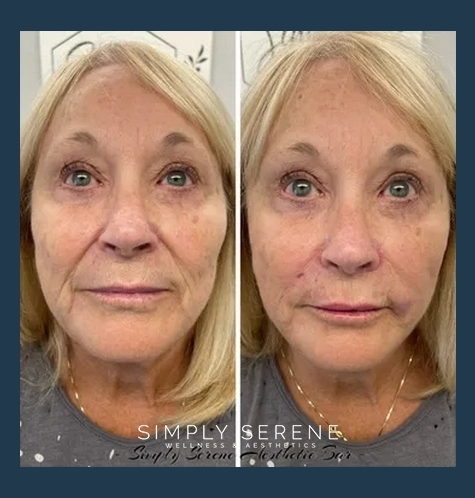Before and After Old Women Nasolabial FoldSmile Lines Treatment Image | Simply Serene Wellness and Aesthetics | St. Cloud, MN