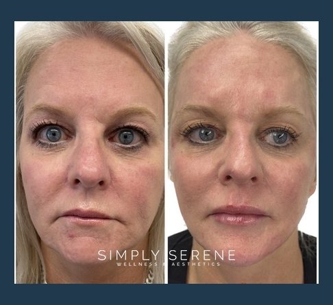 Before and After Simply Signature treatment results | Simply Serene Wellness and Aesthetics in St. Cloud, MN
