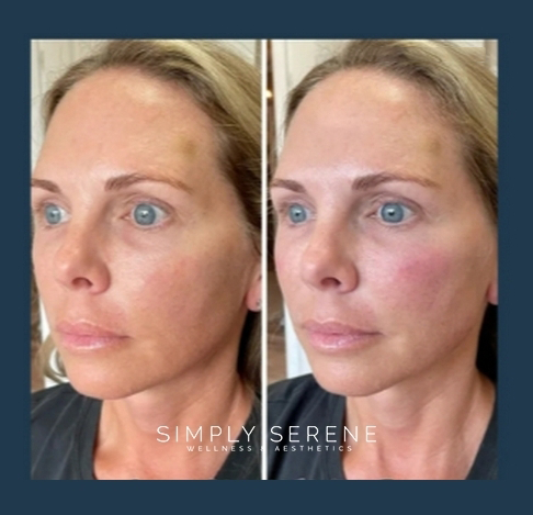 Before and After Women Simply Signature Treatment Image | Simply Serene Wellness and Aesthetics | St. Cloud, MN