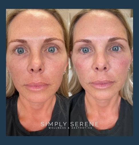 Before and After Women Cheek Filler Treatment Image | Simply Serene Wellness and Aesthetics | St. Cloud, MN