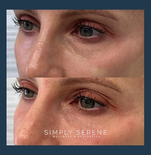 Before and After Undereye Filler treatment results | Simply Serene Wellness and Aesthetics in St. Cloud, MN