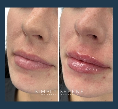 Before and After Lips treatment results | Simply Serene Wellness and Aesthetics in St. Cloud, MN