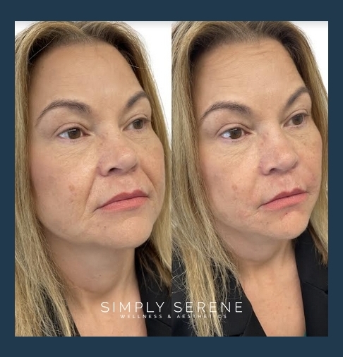 Before and After Nasolabial Folds treatment results | Simply Serene Wellness and Aesthetics in St. Cloud, MN