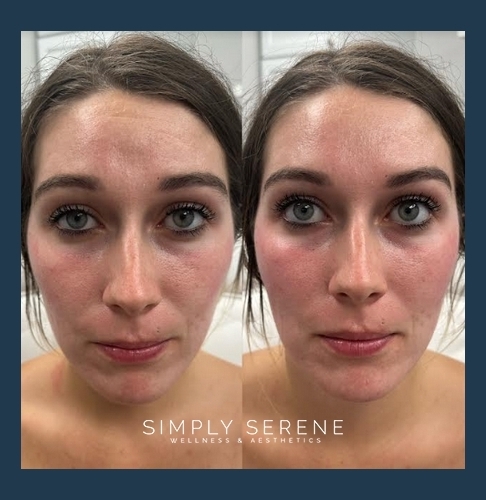 Before and After Young Women Cheek Filler Treatment Image | Simply Serene Wellness and Aesthetics | St. Cloud, MN