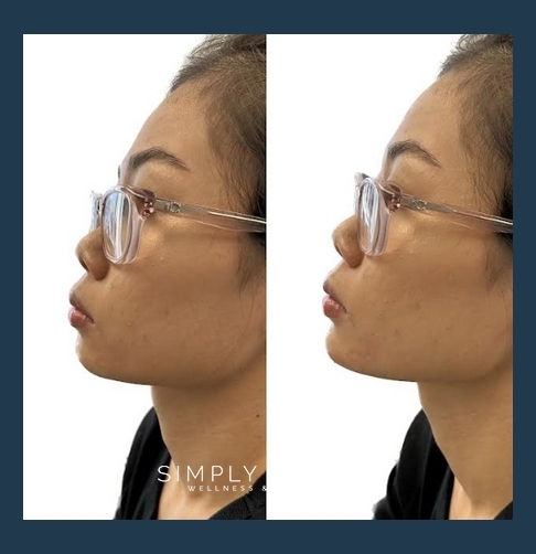 Before and After Chin Filler Treatment Image | Simply Serene Wellness and Aesthetics | St. Cloud, MN