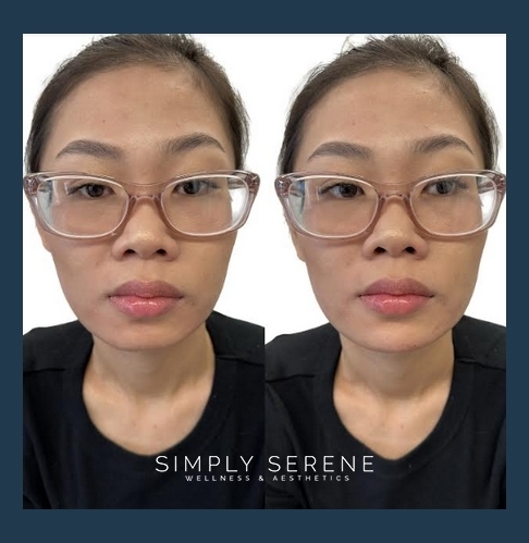 Before and After Women Chin Filler Treatment Image | Simply Serene Wellness and Aesthetics | St. Cloud, MN