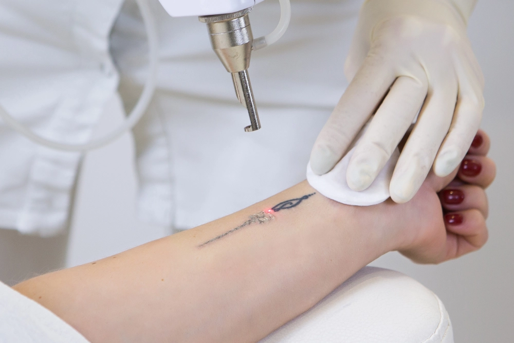Benefits of Tattoo Removal