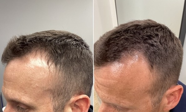 Hair Restoration