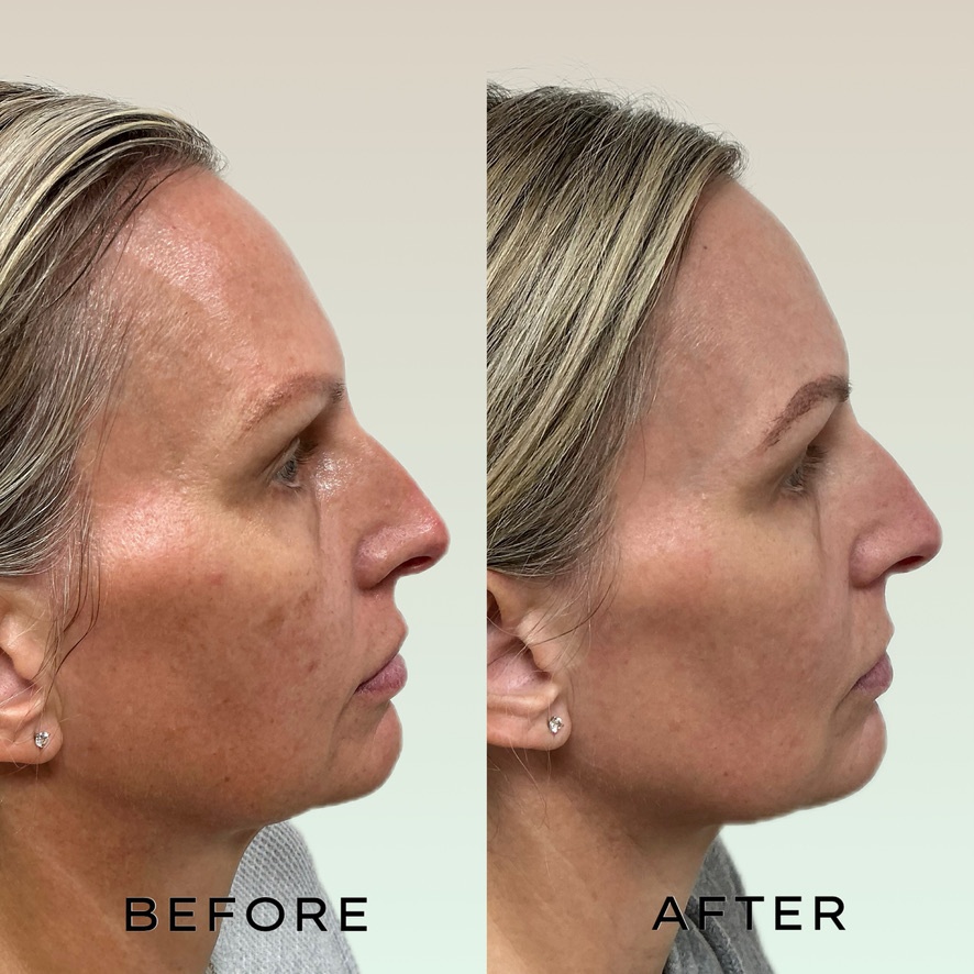 Signature Laser Service