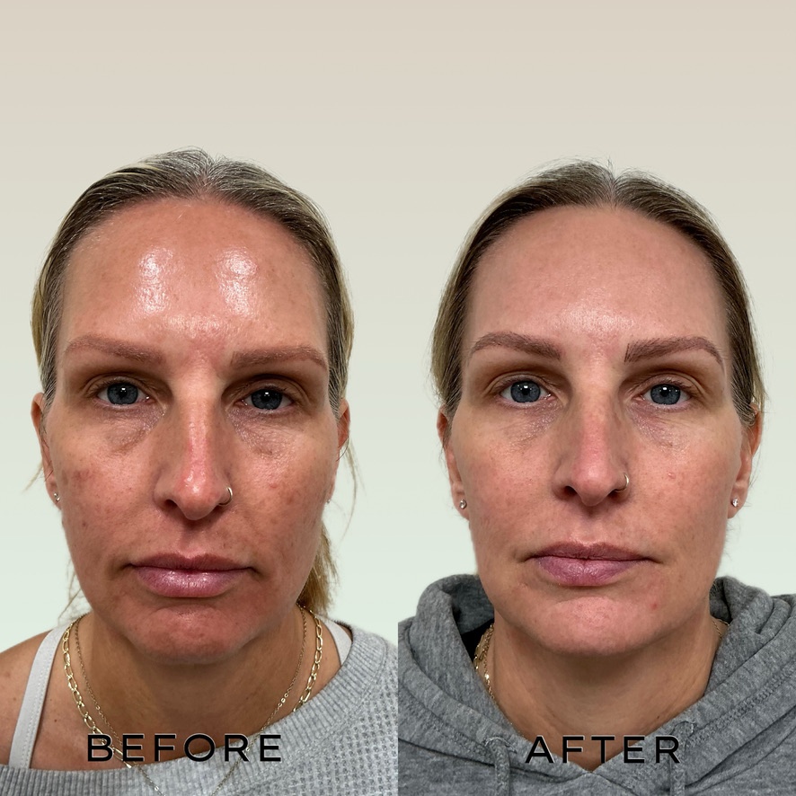 Signature Laser Service