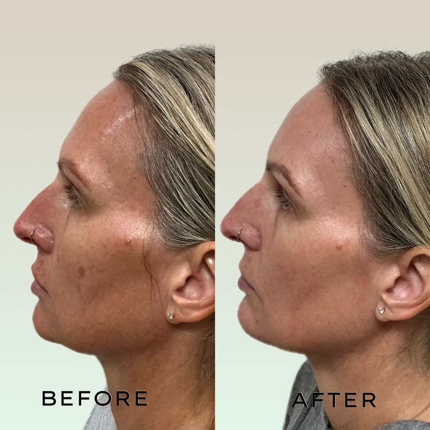 Signature Laser Service