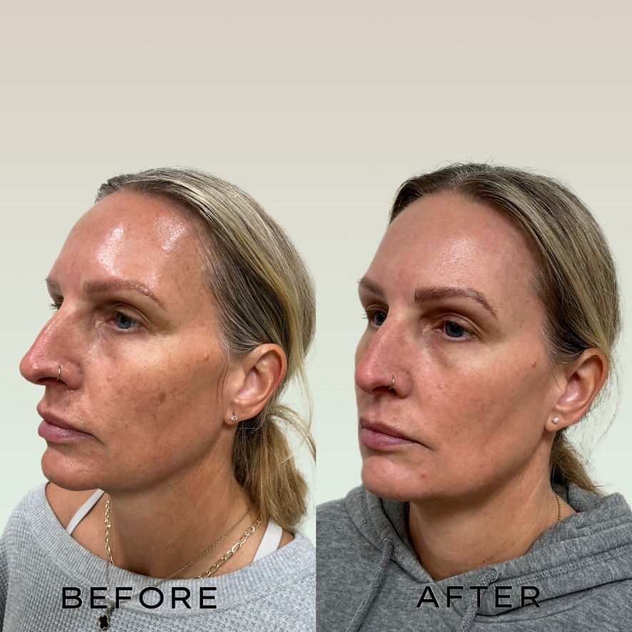 Signature Laser Service