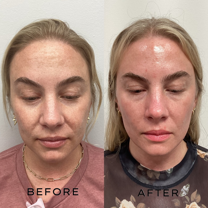 Signature Laser Service