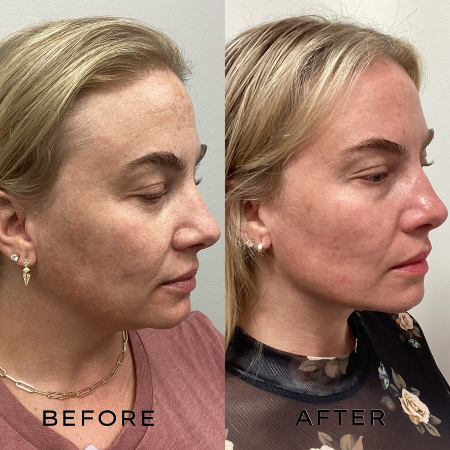 Signature Laser Service