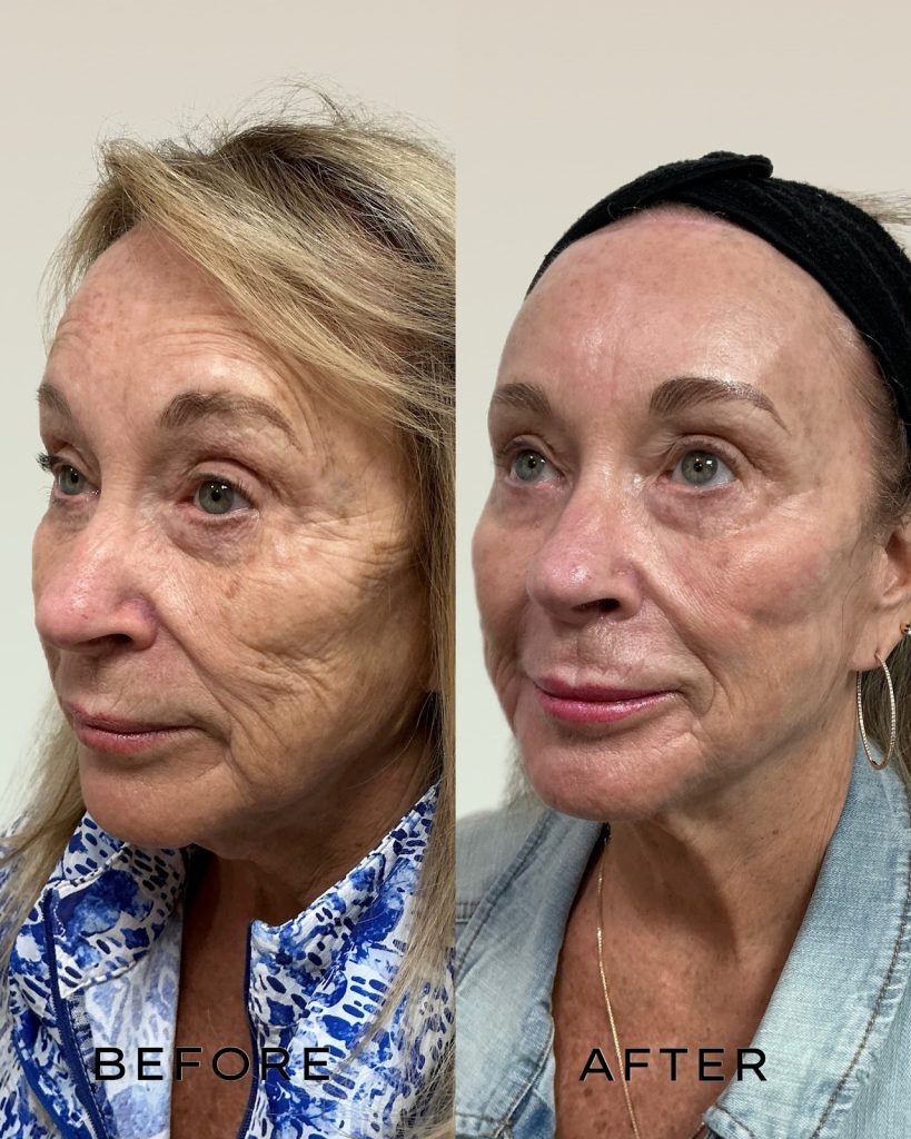 Signature Laser Service