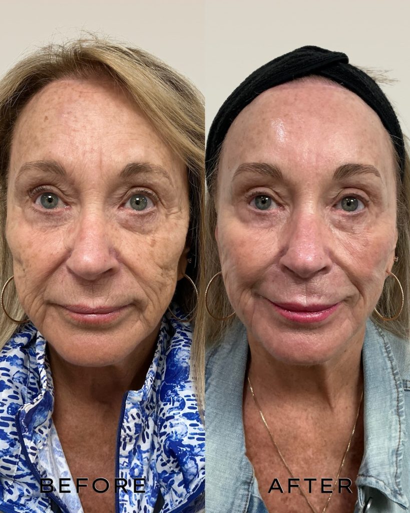 Signature Laser Service