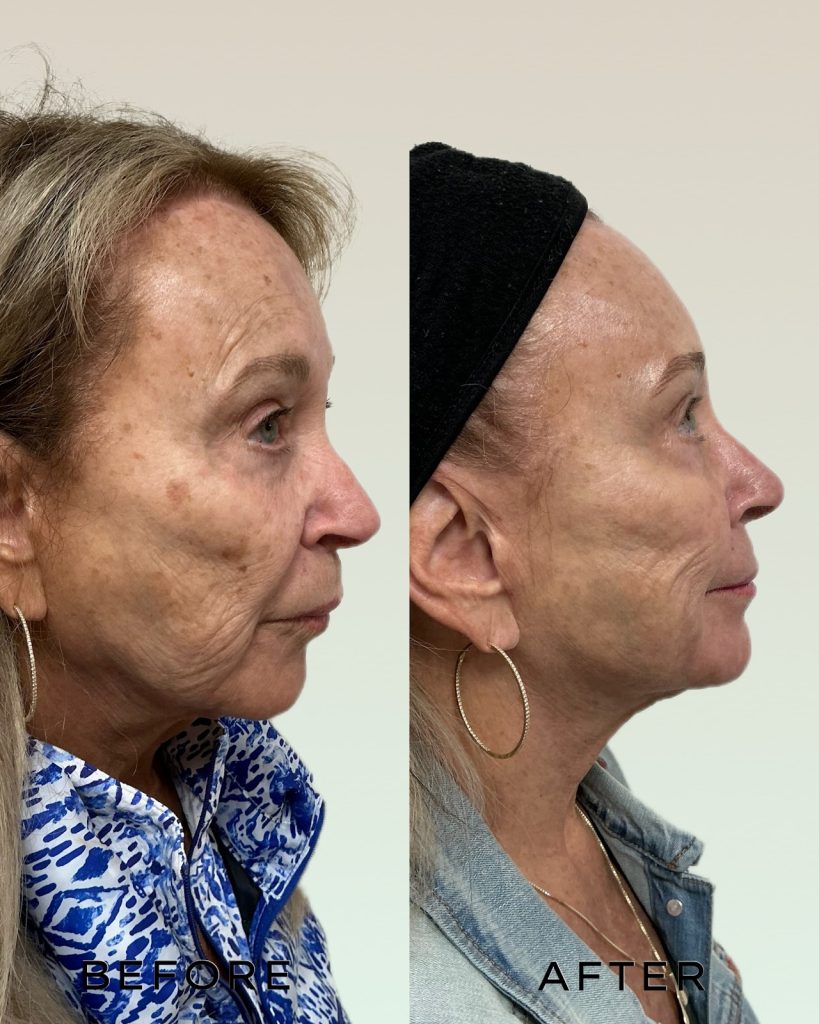 Signature Laser Service