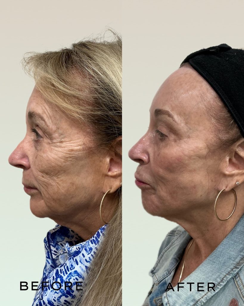 Signature Laser Service