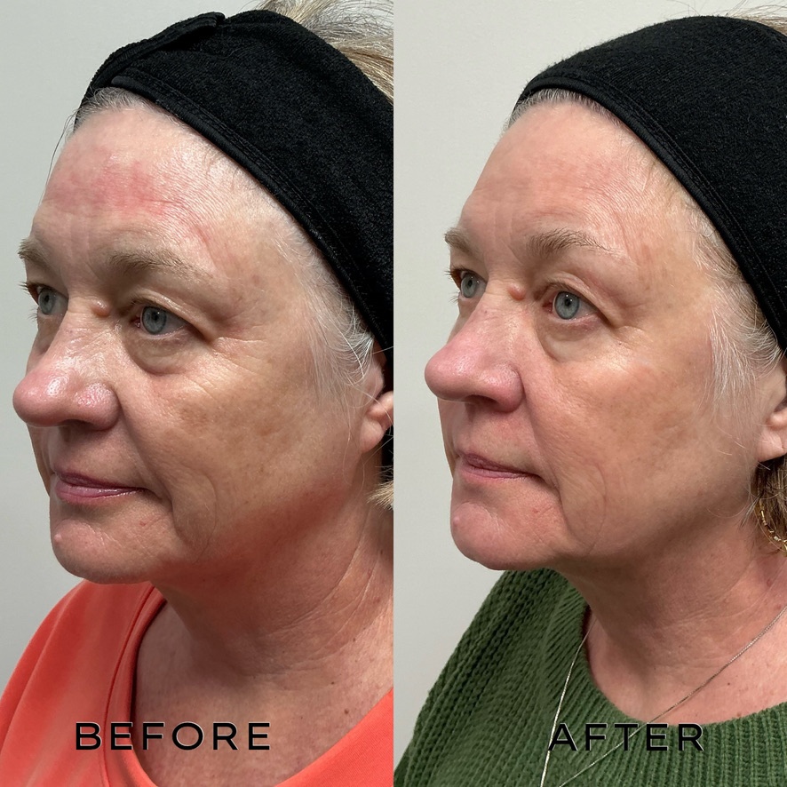 Signature Laser Service