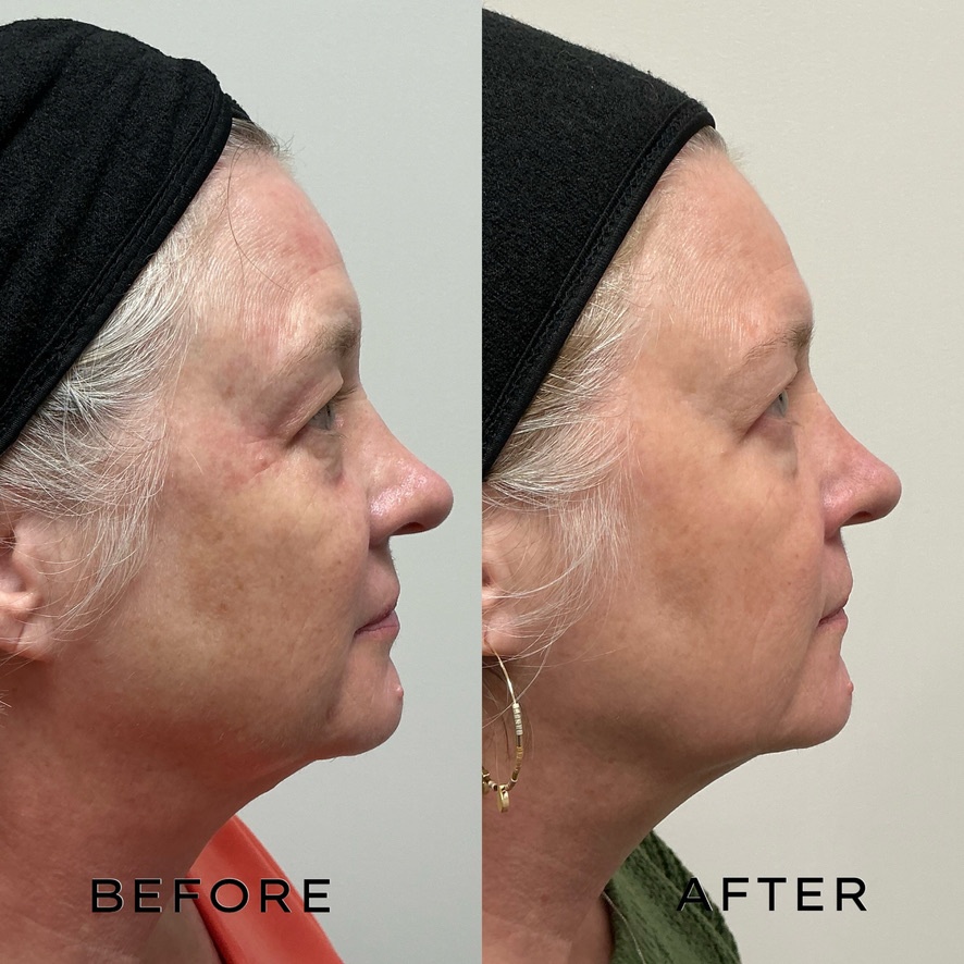 Signature Laser Service