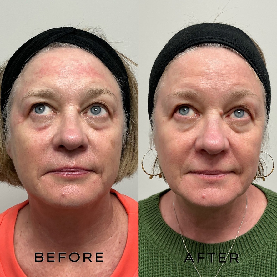 Signature Laser Service